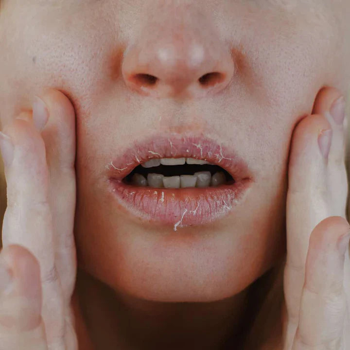 Dry Skin