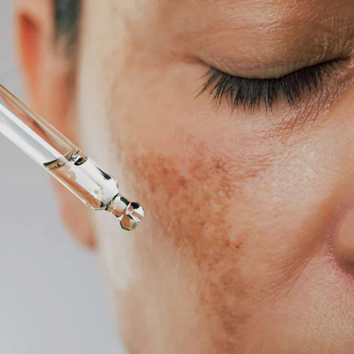 Acne Prone Skin