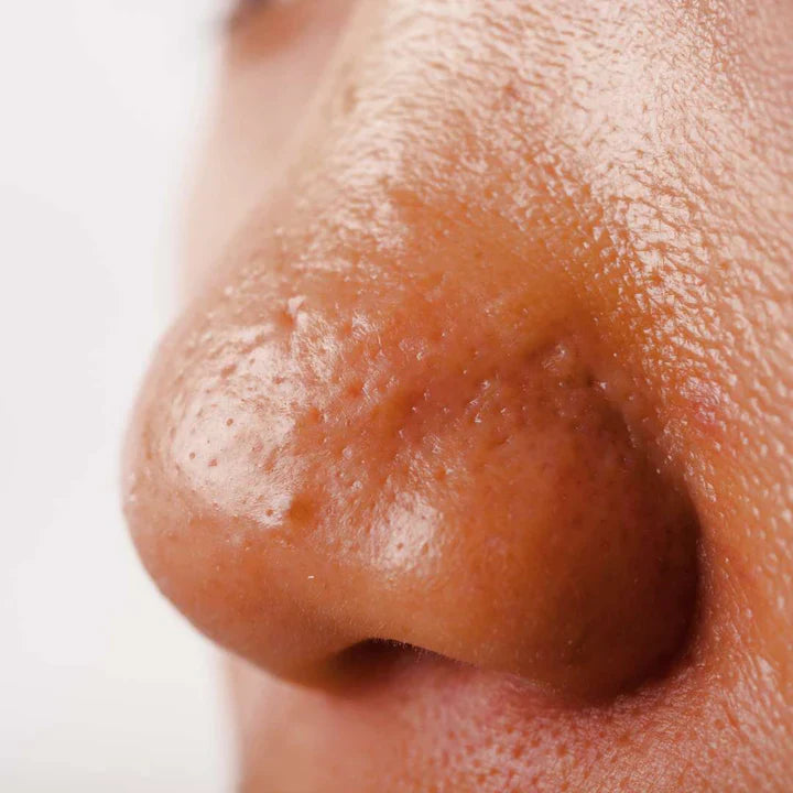 Oily Acne Skin
